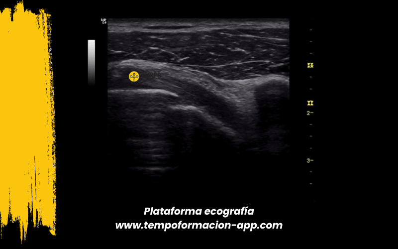 10. Ecografia tempo formacion manguito rotador tendon supraespinoso infraespinoso redondo menor subescapular.png